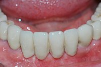 Ce presupune un implant dentar