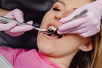 Tipuri de implant dentar Megagen si beneficiile pe care acestea ti le ofera